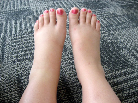 swollen ankles after walking in flip flops